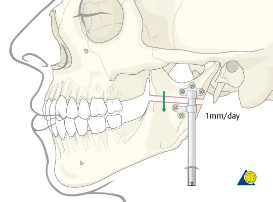 How To Widen straighten Ramus And Increase Angularity Of Gonions 