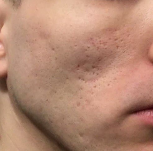 Acne