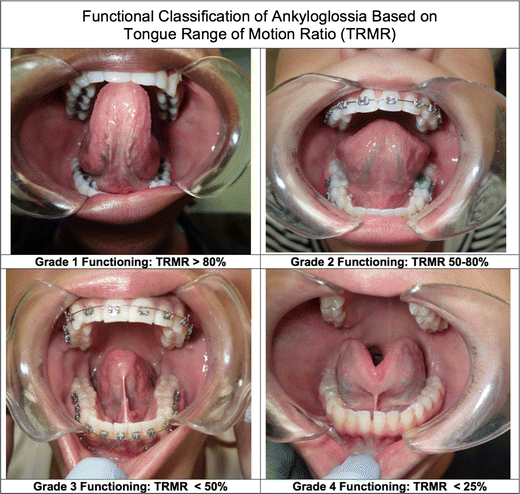 A grading scale for the functional classification of ankyloglossia is proposed based on