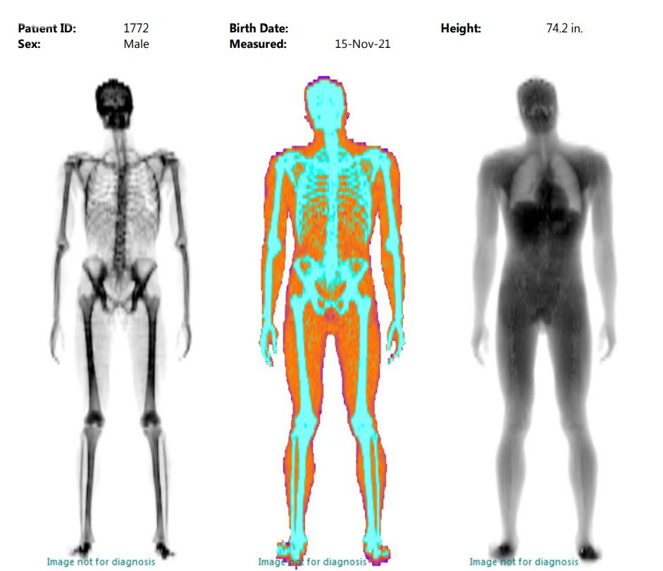 Dexa
