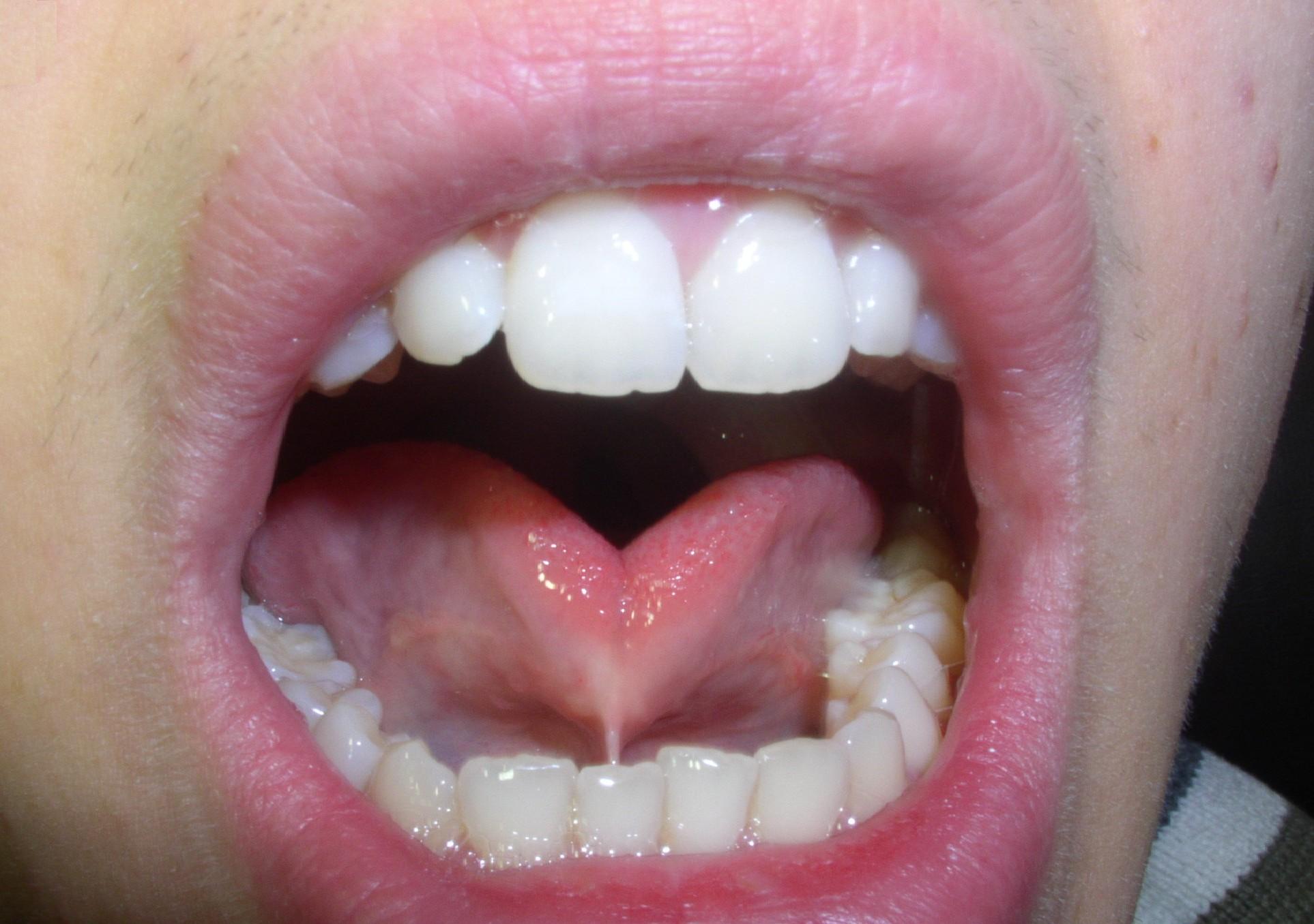 Frenulum linguae