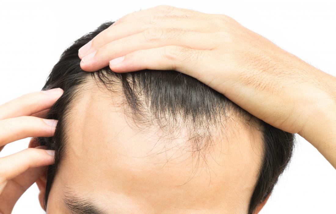 Man with receding hairline