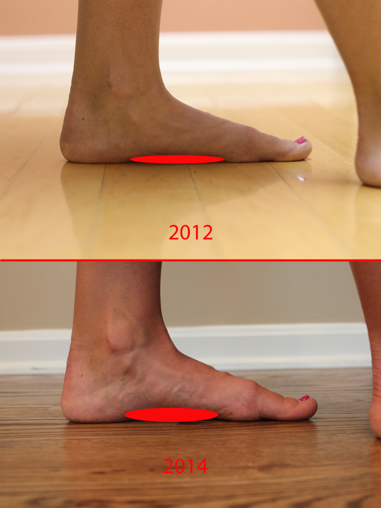 Lateral before after with arch fill 768x1024