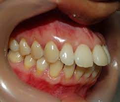 Protrusions: Point Me In The Right Direction - Vibrant Smiles Mableton GA  Dentist Dr Chea Rainford
