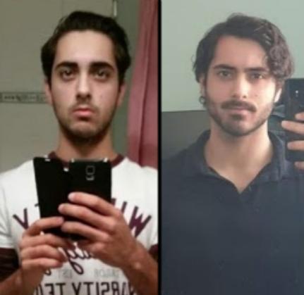 Mewing before after result adult five years