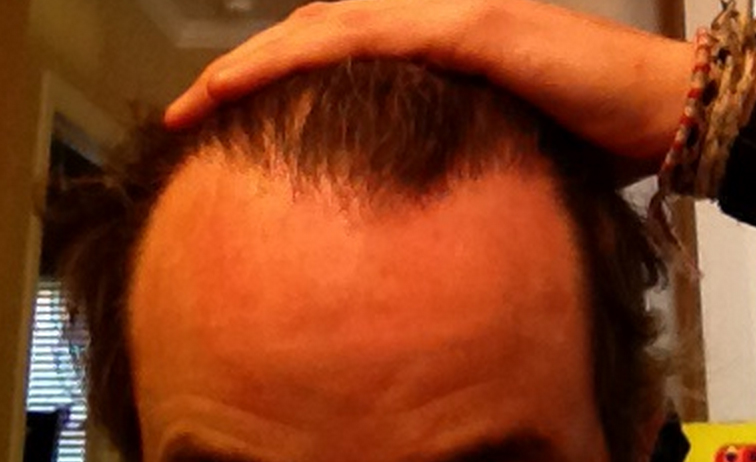 Uneven hairline
