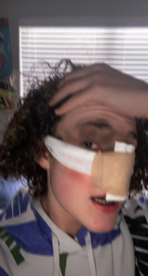 james nose job 3.png