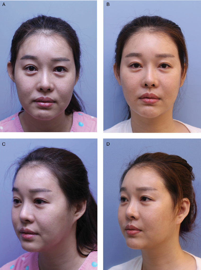This 40 year old woman underwent a high SMAS facelift and fi nger assisted facial spaces