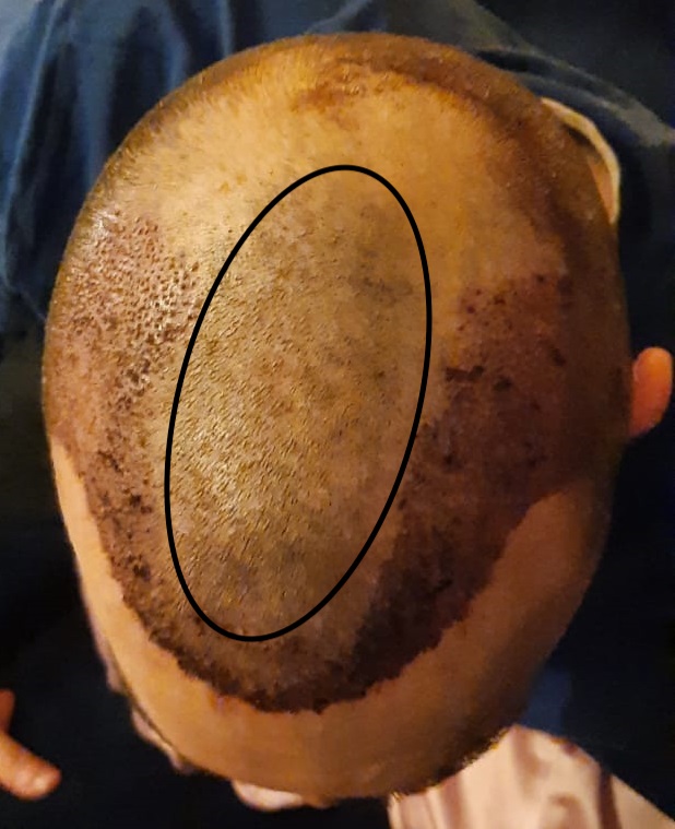 2730694 hairtransplant2