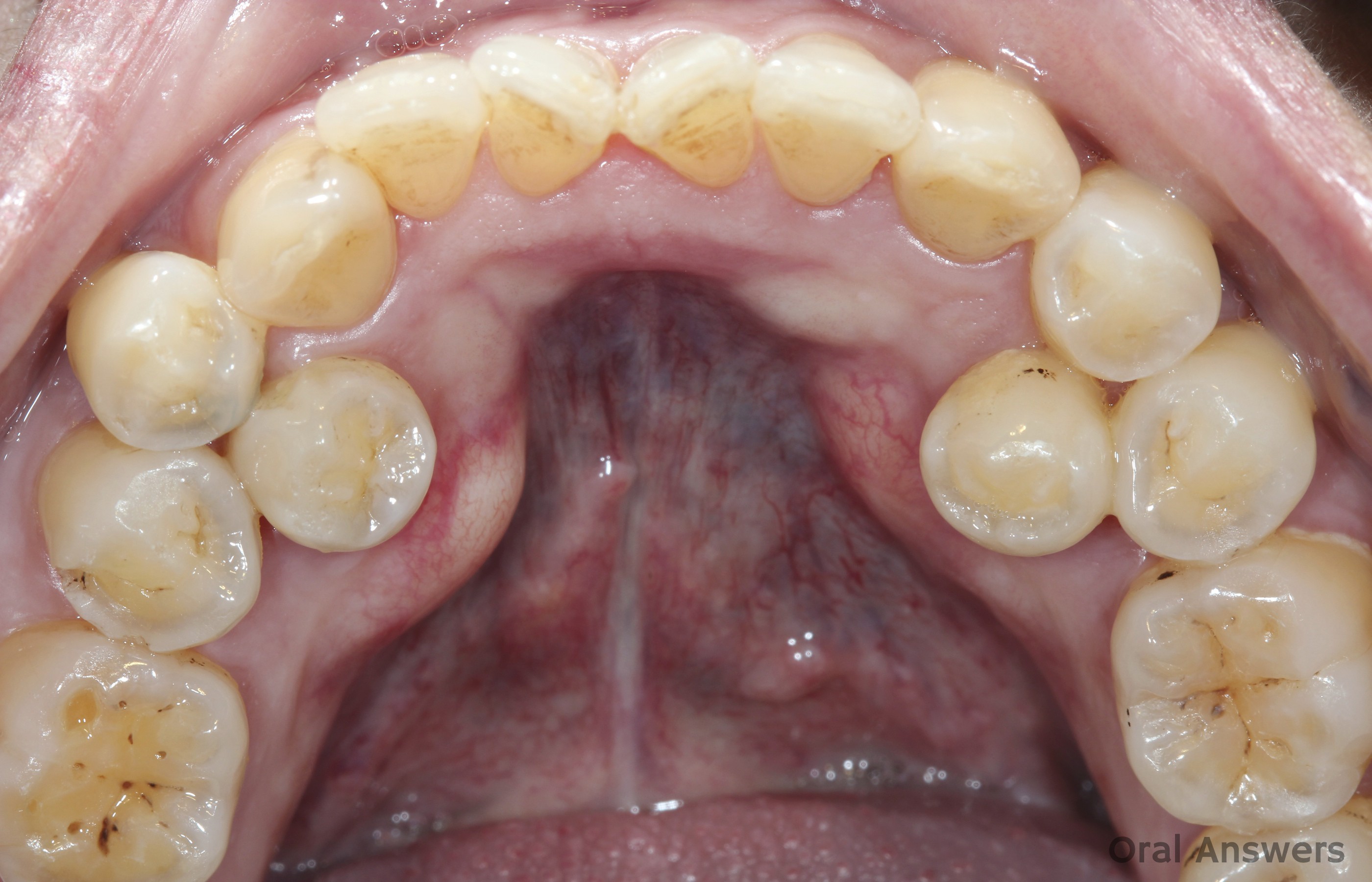 Supernumerary teeth premolars