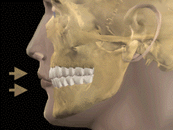 Retruded dentition  2370581 Dpkw