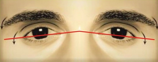 Negative canthal tilt inverted v shape