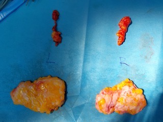 Buccal Gyno