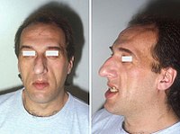 200px Acromegaly prognathism