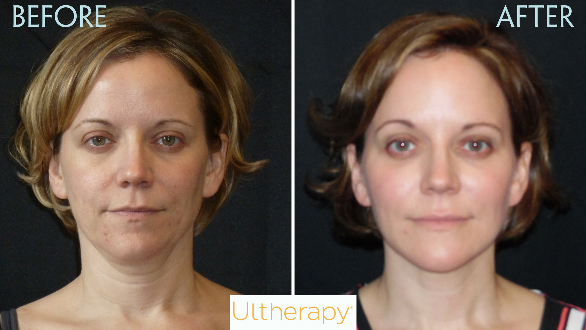 Ultherapy
