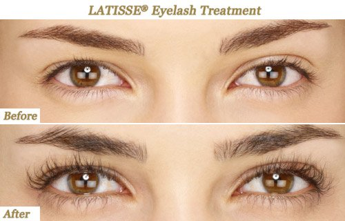 Latisse on eyelashes insane