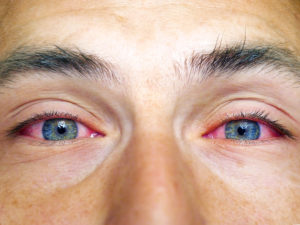 Person with red eyes 300x225