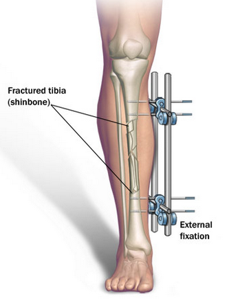 Limb lengthening surgery aurangabad