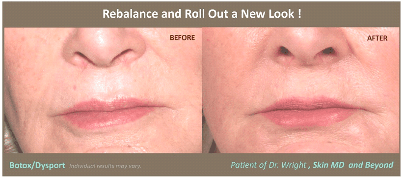 Lip Enhancement9