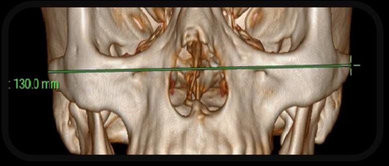Fig 1 Figure showing Bi Zygomatic measurement of facial width Bi Zygomatic Length
