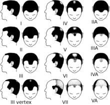 220px Partial Norwood scale for male pattern baldness