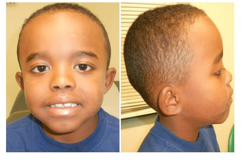 Photograph of patient showing mid face hypoplasia and flat nasal bridge