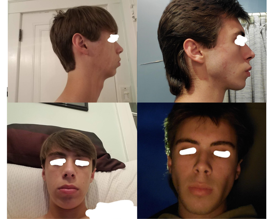 MEWING TRANSFORMATION2