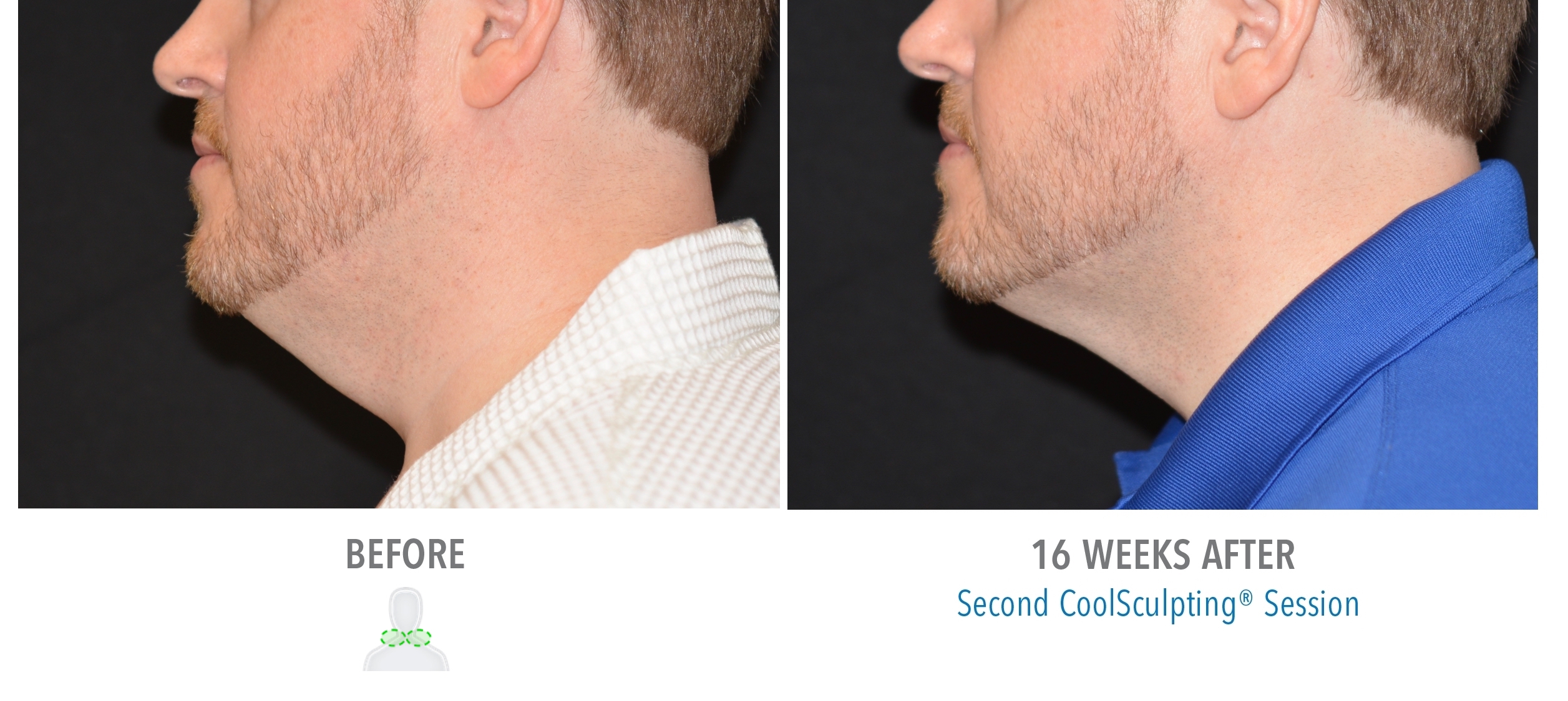 Neck skin