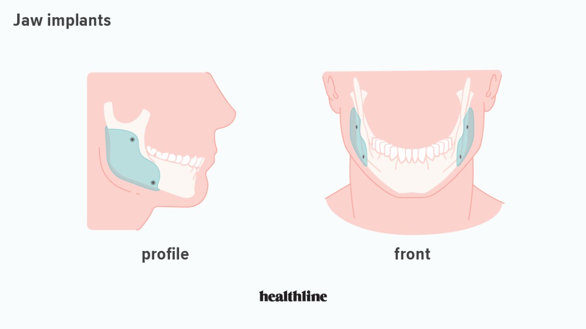 347766 Everything You Want to Know About Jaw Implants 1296x728 body