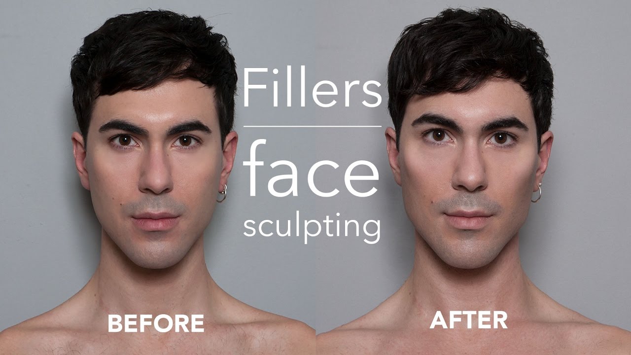 Cheek filler gay