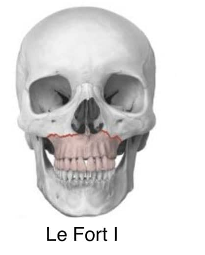 Lf