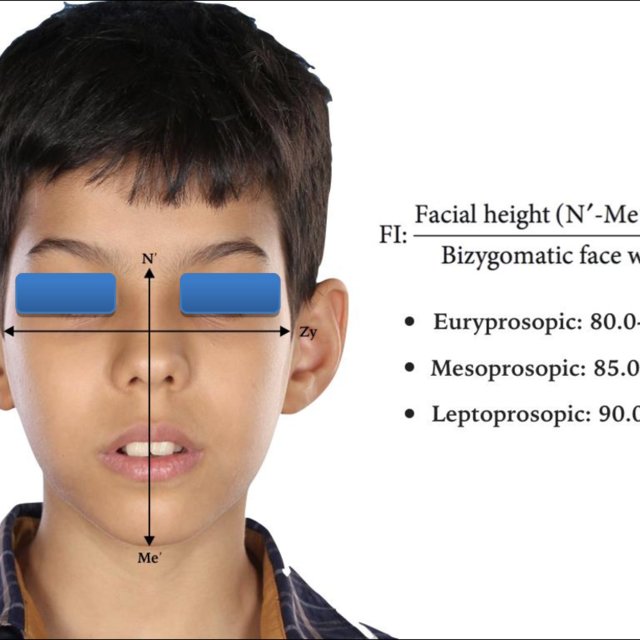 Facial Index facial height to width ratio Significant asymmetry Vertical asymmetry was Q640