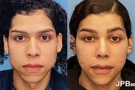 Facial Feminization New York City | FFS Great Neck
