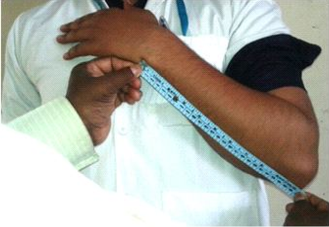 Figure showing measurement of length of Ulna length of right and left ulna were taken