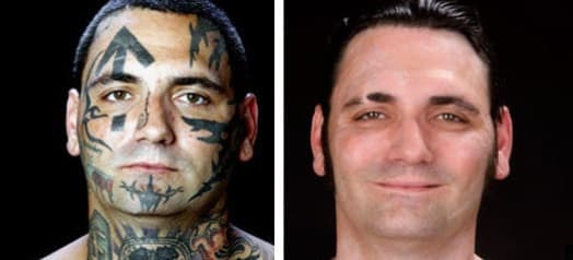 Facial tattoo removed before and after1
