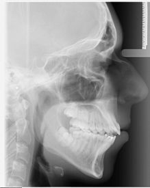 Sidexray324