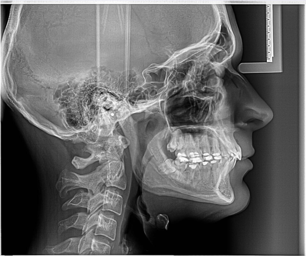 Overbite