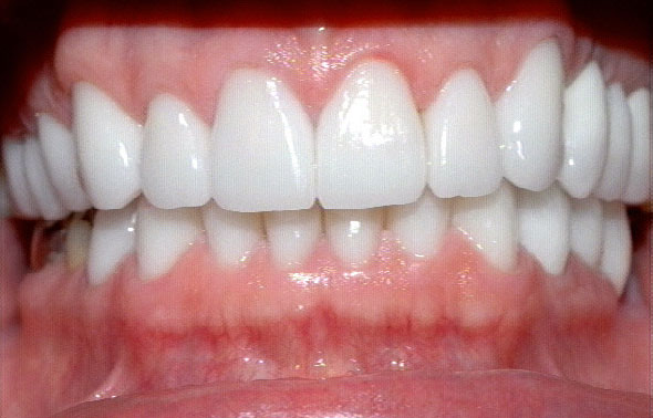 Healthy gum tissue