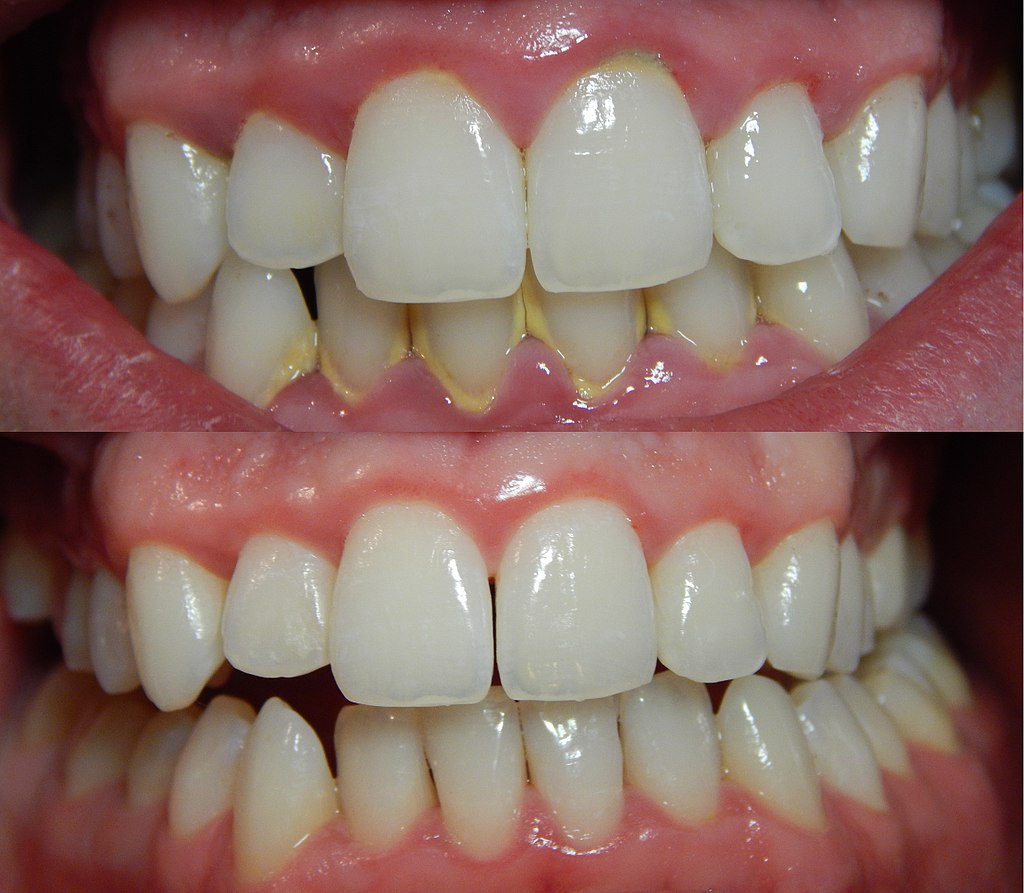 1024px Gingivitis before and after 3