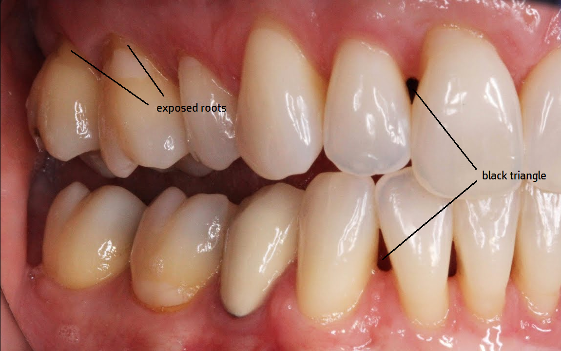 Gums