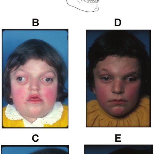 Transcranial monobloc frontofacial advancement for treatment of Crouzon and Apert Q640