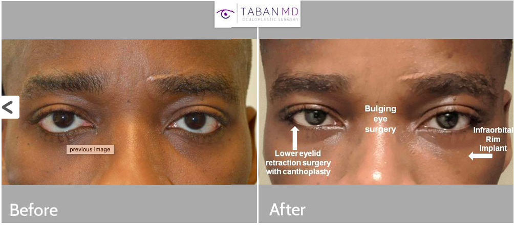 Tabanmd 3