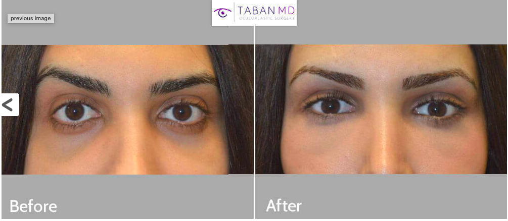 Tabanmd 2