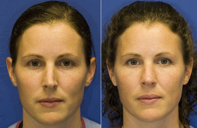 Patient 8 frontal
