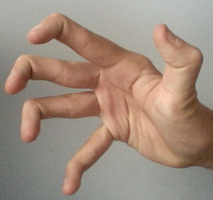 300px Hypermobile fingers and thumb
