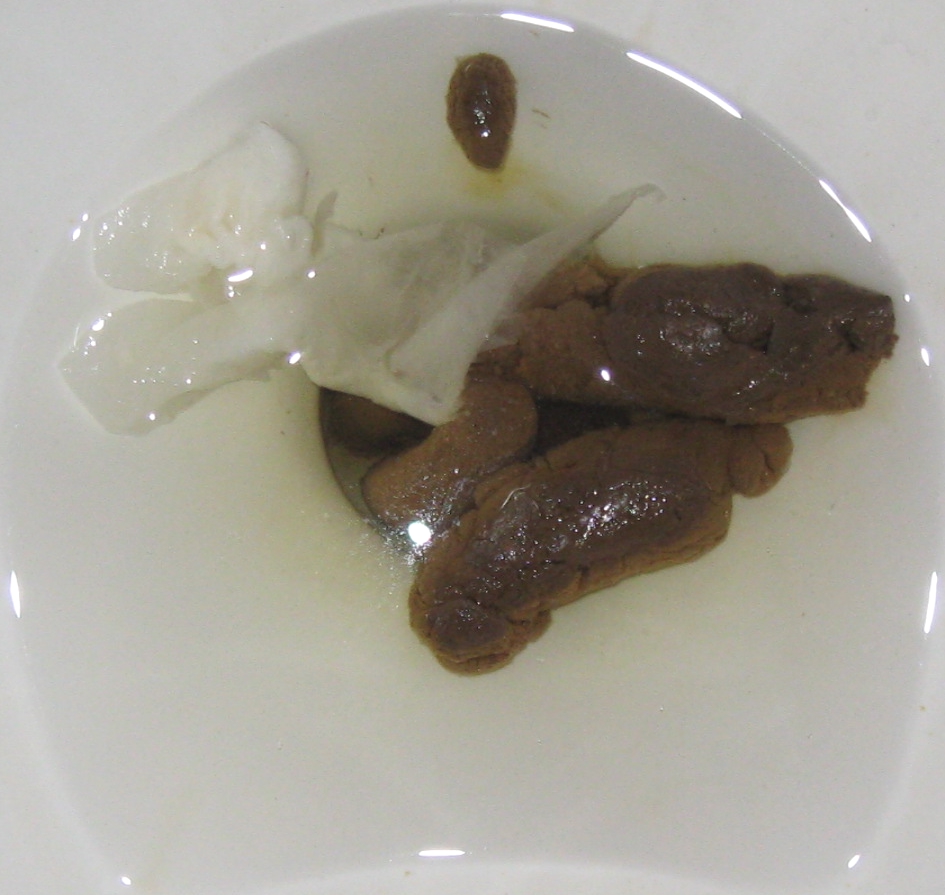 Human feces in toilet