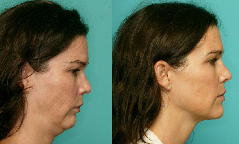 img-jaw_surgery-4.jpg