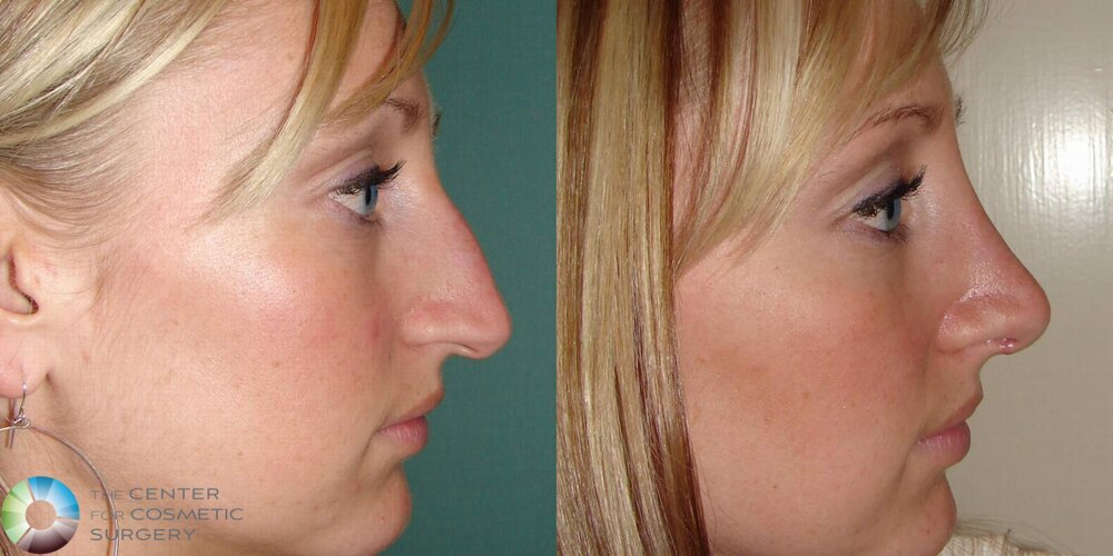rhinoplasty-501-right-side-detail.jpg