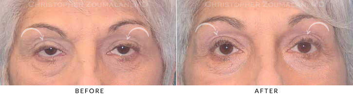 ptosis-surgery-gal-1a.jpg