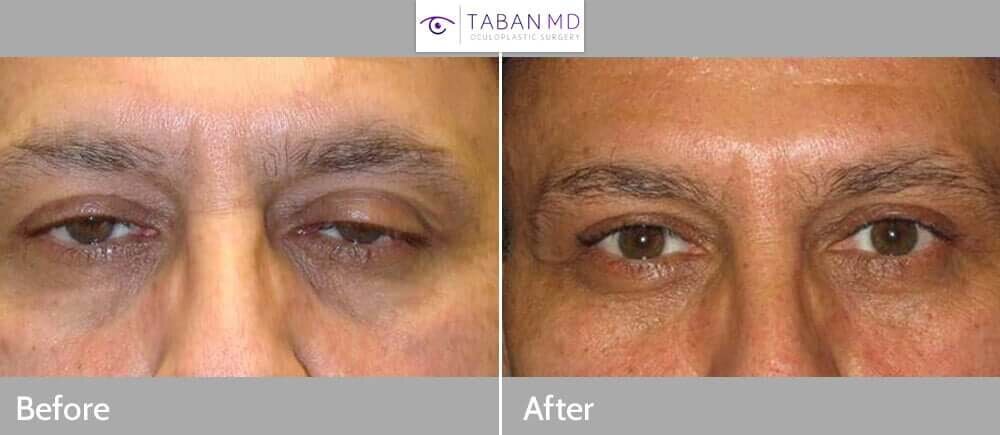 droopy-eyelid-ptosis-1.jpg
